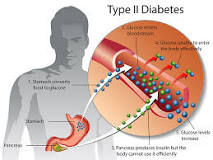 Type 2 Diabetes